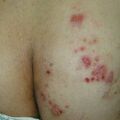 misuse_tricort_bactroban020904.jpg