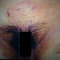 misuse_tricort_dermavate9-662.jpg