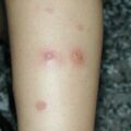 misuse_trinazoleg010710.jpg