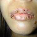 misuse_vacrovir010423.jpg