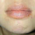 misuse_vacrovir010608.jpg