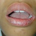 misuse_vacrovir010611.jpg