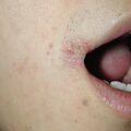 misuse_vacrovir010626.jpg