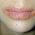 misuse_vacrovir010630.jpg
