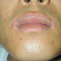misuse_vacrovir020731.jpg