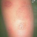 misuse_vacrovir2000-220.jpg