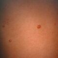molluscum9-384.jpg