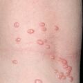 molluscum_contagiosum.jpg