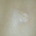 morphea010228.jpg