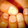 naildystrophy1.jpg