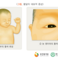 neonatal_jaundice_0205102234v_l.png