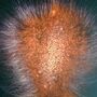 neurodermatitis9-788.jpg