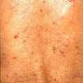 neurofibroma445.jpg