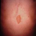 neurofibromatosis2000-168.jpg