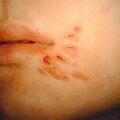 neuroticherpes.jpg