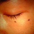 nevus1.jpg
