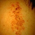 nevuscomedonicus.jpg