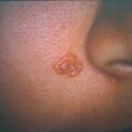 nevussebaceus1.jpg