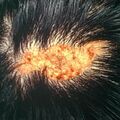 nevussebaceus2.jpg