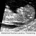 nuchal_abnormal.jpg