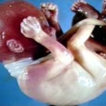 nuchal_cord-163245.png
