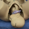 nuchal_cord-163433.png