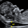 nuchal_translucency_4057.png
