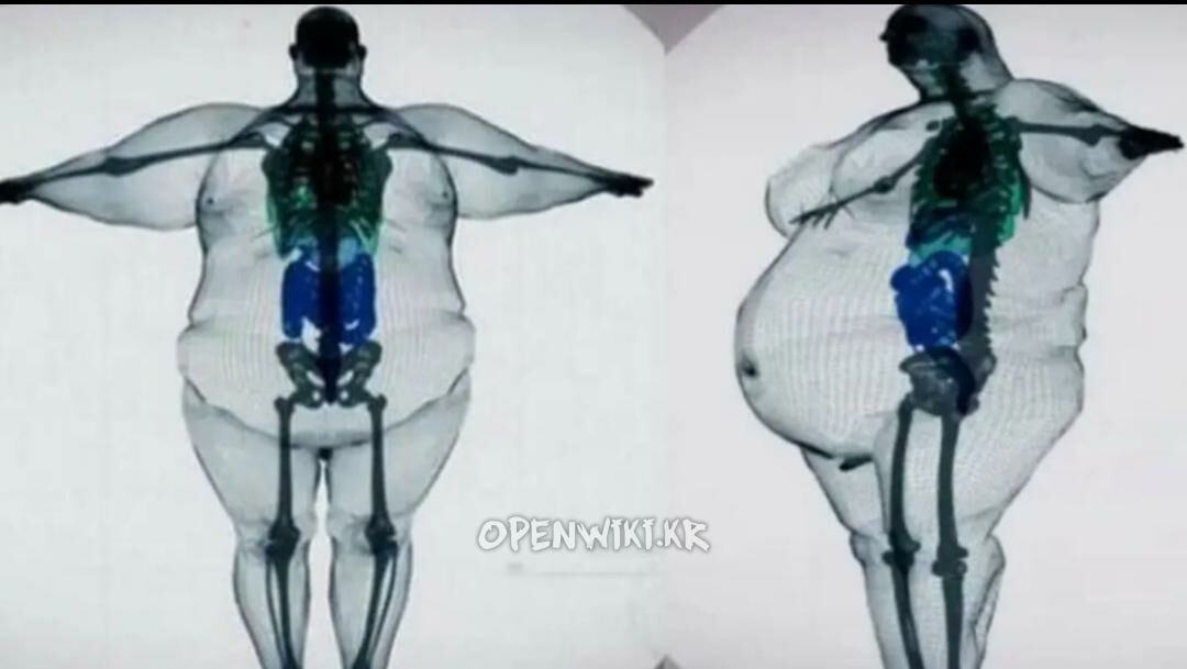 obesity.jpg
