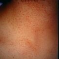 obstructivepurpura9-770.jpg