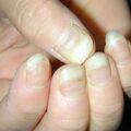 onycholysis010929-2.jpg