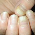onycholysis010929-3.jpg