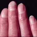 onycholysis_0525142700.png