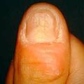 onychophagia9-340.jpg
