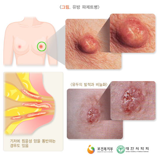paget_s_disease_0701150125.png