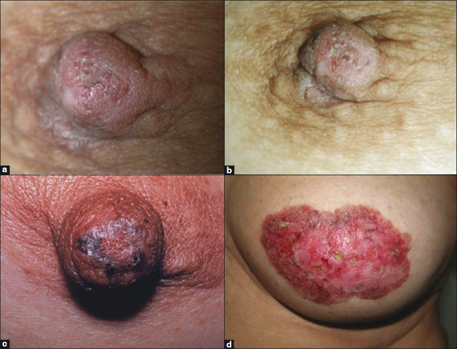Figure 1: (a and b) Paget's disease of the nipple. The clinical appearance is usually a thickened, eczematoid crusted lesion with irregular borders. (c) Scaly, erythematous, crusty pigmentation and thickened plaques on the nipple, spreading to the surrounding areolar areas. (d) Advanced lesions show skin thickening, redness, erythema, erosion of the nipple and scaling around the nipple-areola