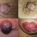 paget_s_disease_0701152954.png