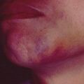 painfulbruisingsyndrome8-386.jpg
