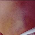 painfulbruisingsyndrome8-387.jpg