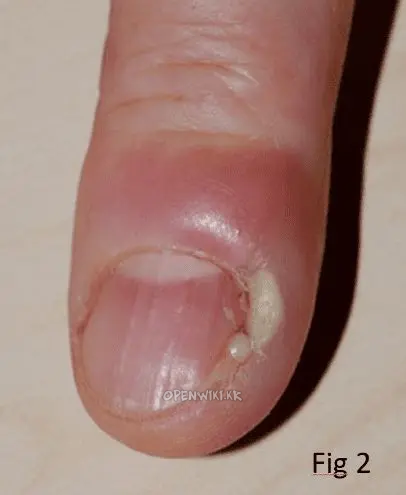 paronychia_5639.png