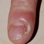 paronychia_5639.png