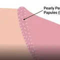 pearly_penile_papules.webp