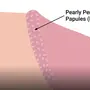 pearly_penile_papules.webp