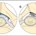 percutaneous_epidural_neuroplasty_2150.png