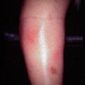 periarteritisnodosa9-405.jpg