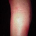 periarteritisnodosa9-407.jpg