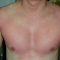 photoallergy010910-1.jpg