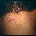 photosensitivity2.jpg