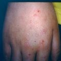 photosensitivity3.jpg