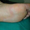 pittedkeratolysis010321.jpg