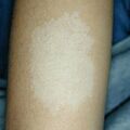pityriasis_alba010116.jpg
